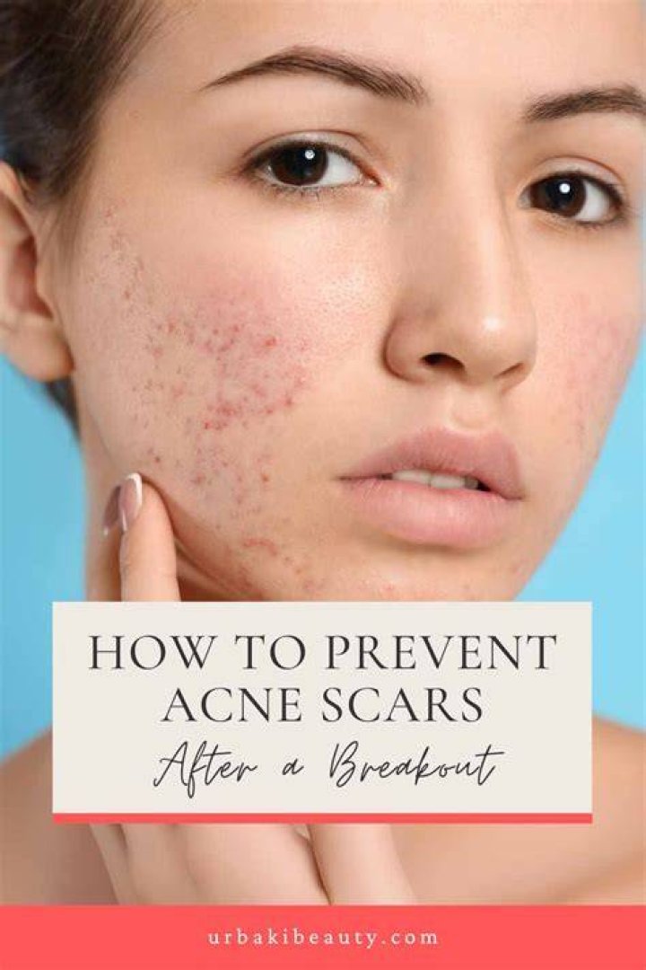 How To Prevent Acne After Going Off The Pill Dr. Lara Briden SuzyKnew