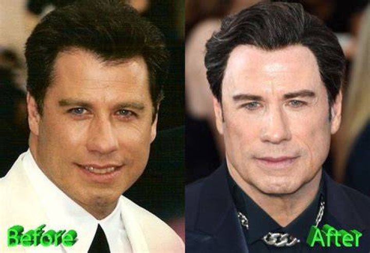 John Travolta after plastic surgery using Botox injections Celebrity