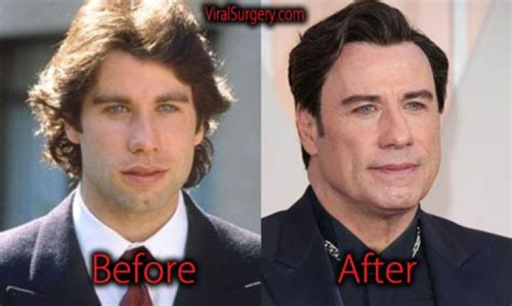 John Travolta Botox SurgeryStars