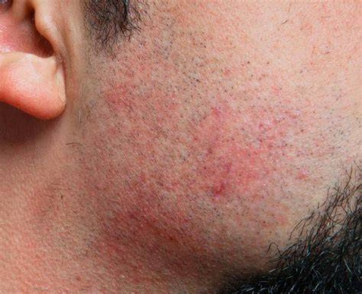 razor burn shaving rash