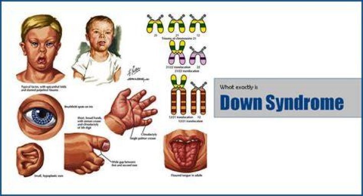 What Exactly is Down Syndrome?